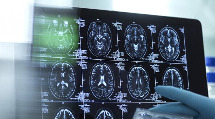 لحظة تاريخية في سباق التغلب على ألزهايمر .. دواء تجريبي واعد يُبطئ المرض في مراحله المبكرة