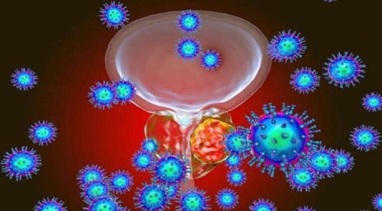 أخصائي أورام يكشف أخطر عمر للإصابة بسرطان البروستاتا