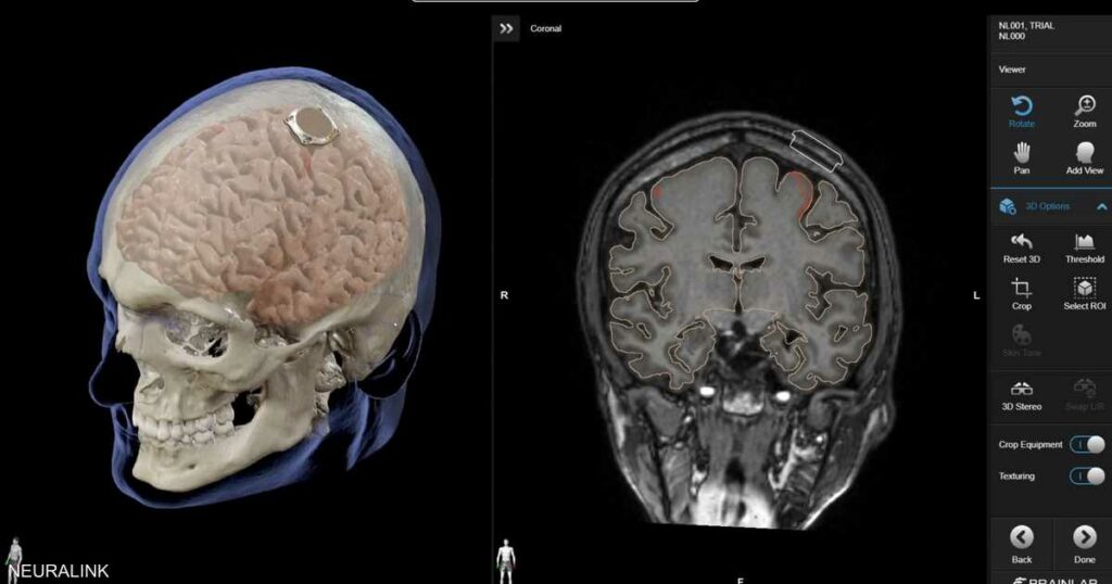 إيلون ماسك يعلن عن نجاح زرع شريحة دماغية في أول إنسان
