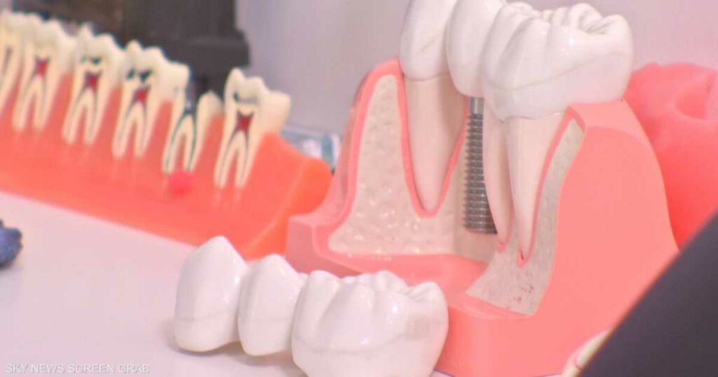 زراعة الأسنان.. بين بريق التجميل وحاجة المريض إليها