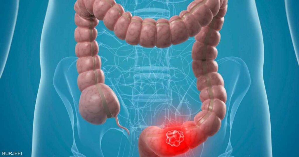 طبيب بريطاني يربط بين المكملات الغذائية وسرطان القولون