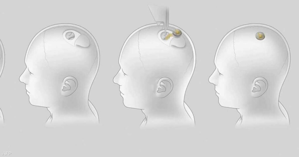 بشرى لمرضى الشلل.. شريحة في الدماغ قد تتيح التحكم بالأدوات