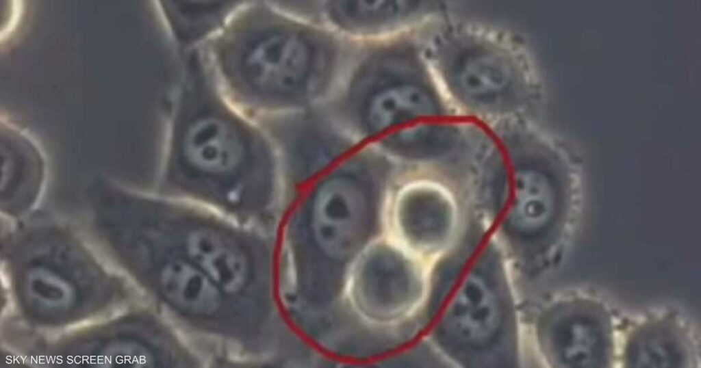 سرطان البنكرياس.. 6 علامات لا يجب تجاهلها أبدا