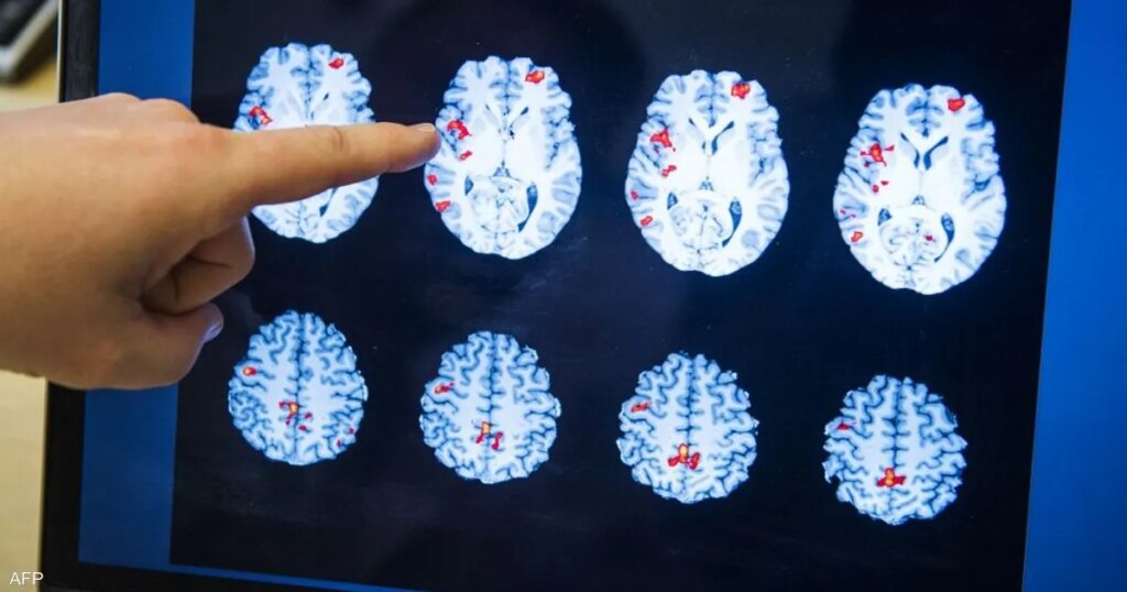 أزمة صامتة تضرب أميركا.. ارتفاع مقلق في الإعاقات الإدراكية