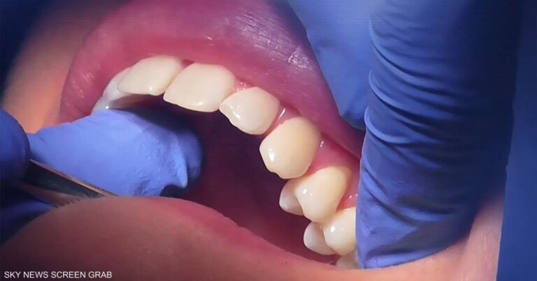علماء يطورون هلاما لإصلاح الأسنان التالفة دون جراحة