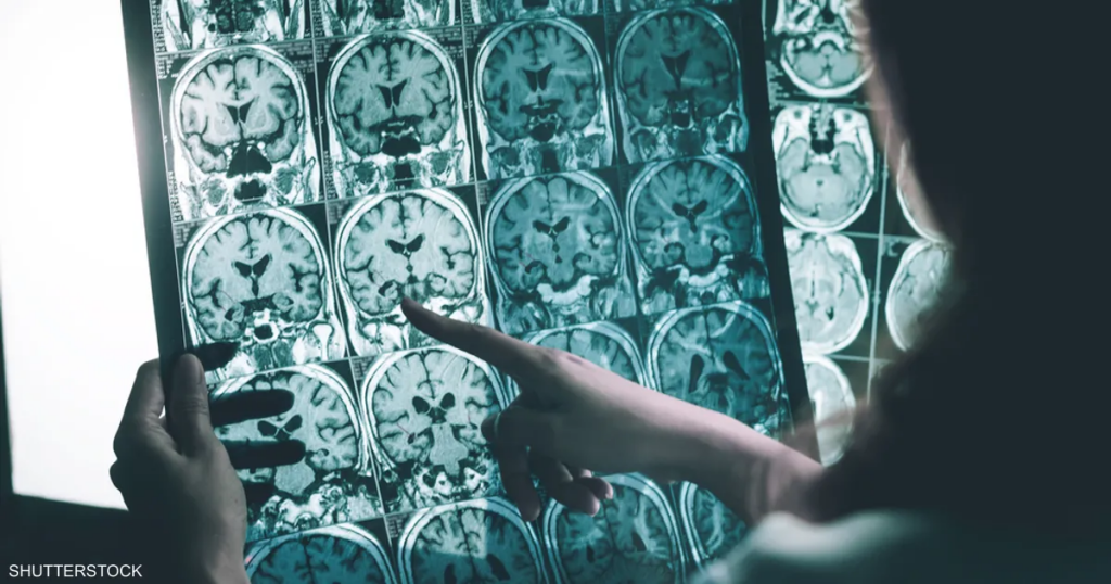 مرحلة ما قبل الأعراض.. دواء جديد يستهدف "شرارة" الزهايمر