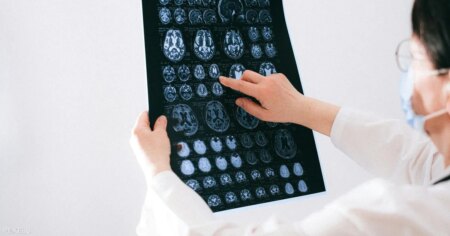 علامات وتحذيرات مبكرة قد تنقذ حياتك من السكتة الدماغية