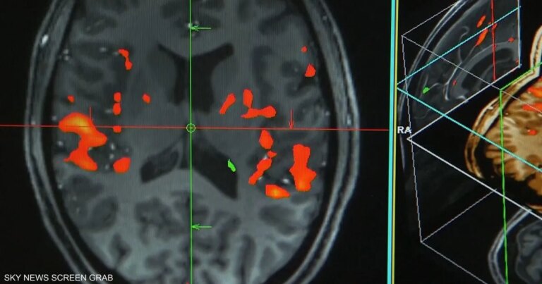 كشف خلل عصبي مؤقت وراء سقوط اللاعب جمال موسيالا