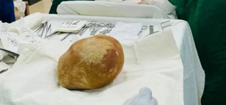 سريلانكا: استخراج حصوة كلوية تزن 3.1 كجم من جسم رجل سريلانكا: استخراج حصوة كلوية تزن 3.1 كجم من جسم رجل